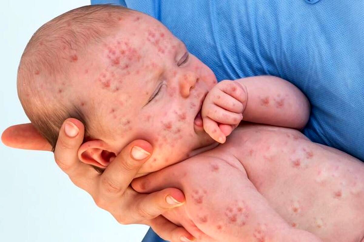زنگ خطر شیوع سرخک در یزد به صدا درآمد