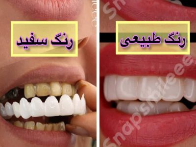 خرید لمینت متحرک دندان بدون دندانپزشکی